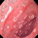 DUODENITIS