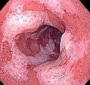 DUODENITIS 