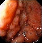 DUODENAL GASTRIC METAPLASIA
