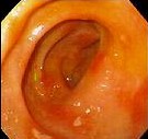 DYODENITIS 