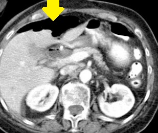 ERCP - DUODENAL PERFORATION