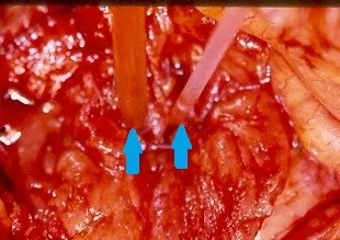 LOCAL EXCISION AMPULLA VATER CARCINOMA