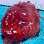 LOCAL EXCISION AMPULLA VATER CARCINOMA