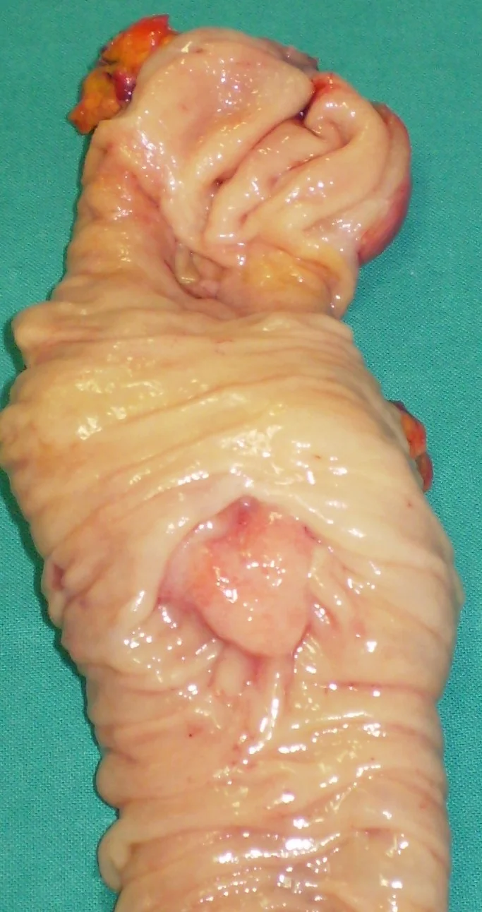AMPULLA VATER CARCINOMA