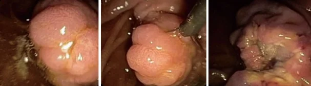 PAPILLA VATER TUMORS