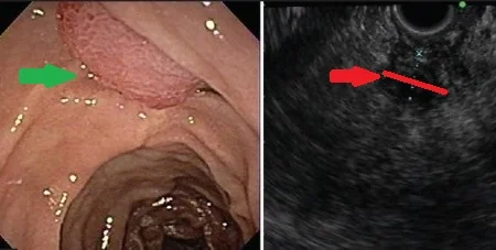 ADENOCARCINOMA PAPILLA VATER