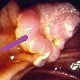 AMPULLA VATER CARCINOMA