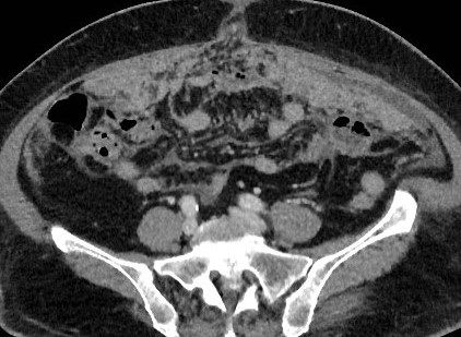 OMENTAL CAKE - CT SCAN