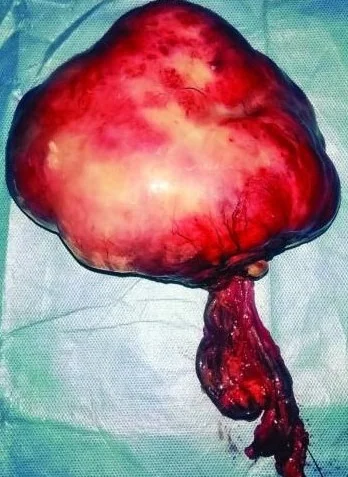 OMENTAL FIBROMATOSIS