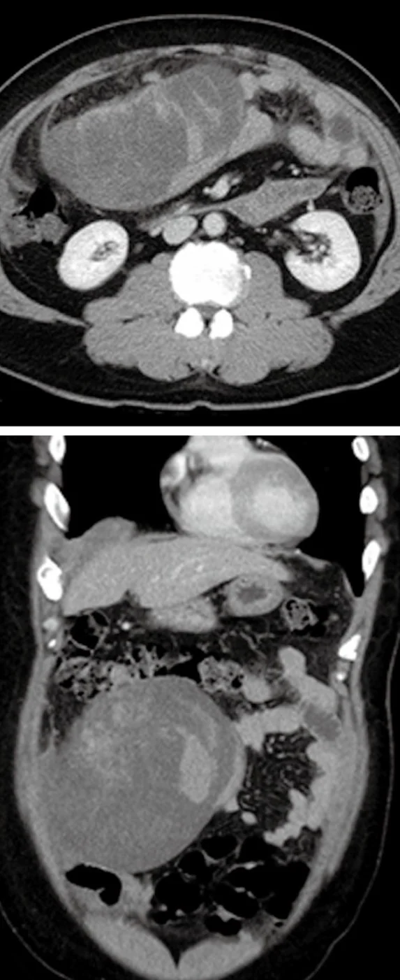 OMENTAL GISTs - MRI IMAGES