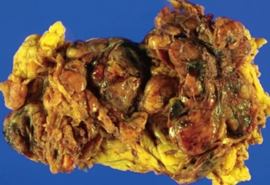 OMENTAL GLOMUS TUMOR