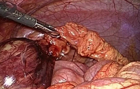 OMENTAL LIPOMA