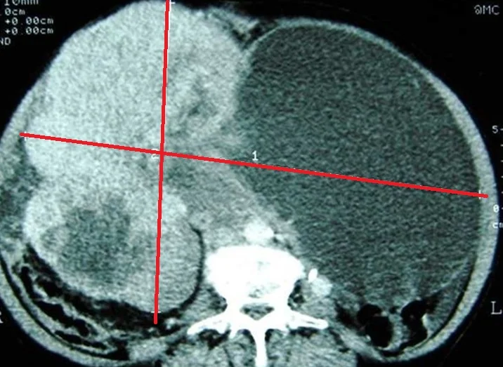 OMENTAL LIPOSARCOMA 