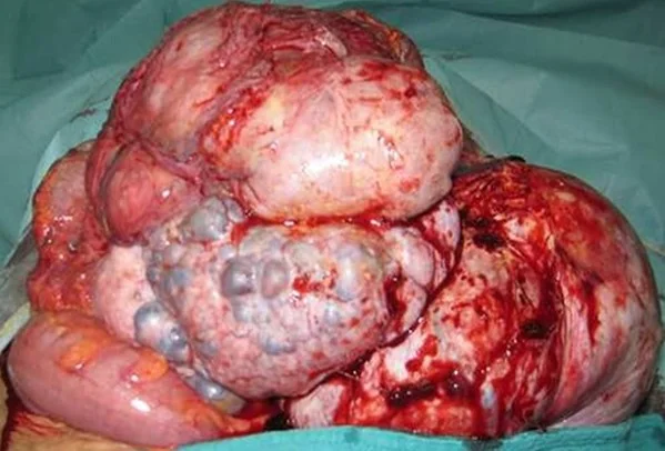 OMENTAL LIPOSARCOMA