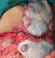 OMENTAL RHABDOMYOSARCOMA