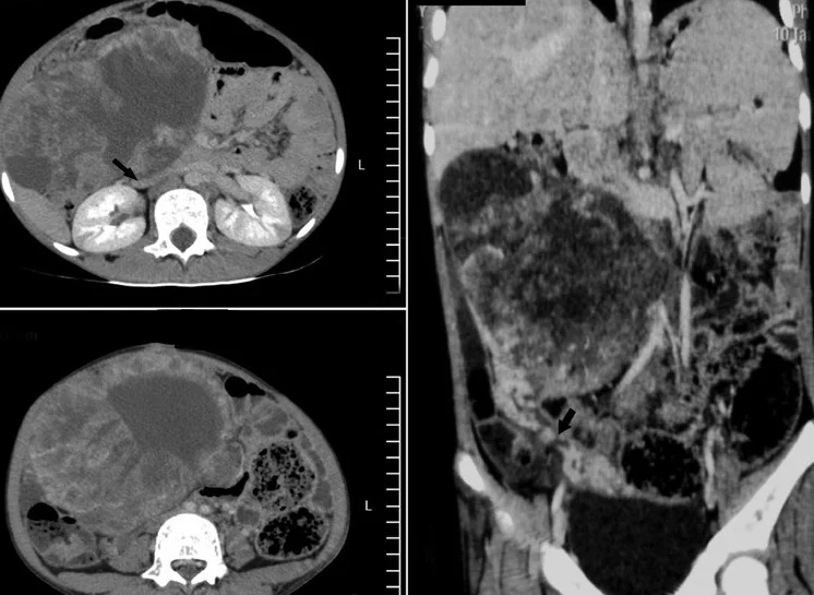 OMENTAL TERATOMA 