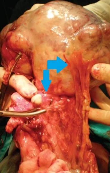 OMENTAL TERATOMA