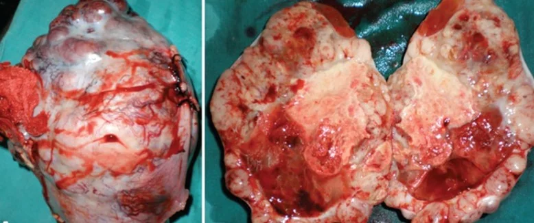 OMENTAL TERATOMA