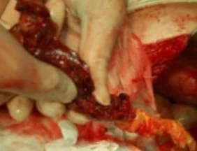 OMENTAL TORSION