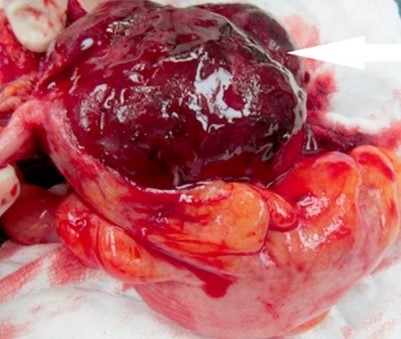 PRIMARY INFLAMMATORY OMENTAL PSEUDOTUMOR