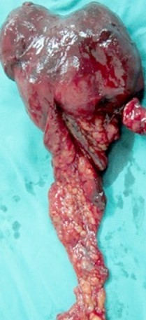 PRIMARY INFLAMMATORY OMENTAL PSEUDOTUMOR