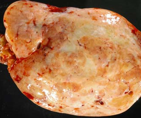 PRIMARY OMENTAL HAEMANGIOPERICYTOMA