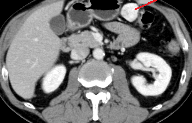 PRIMARY OMENTAL TUMOR - CT SCAN