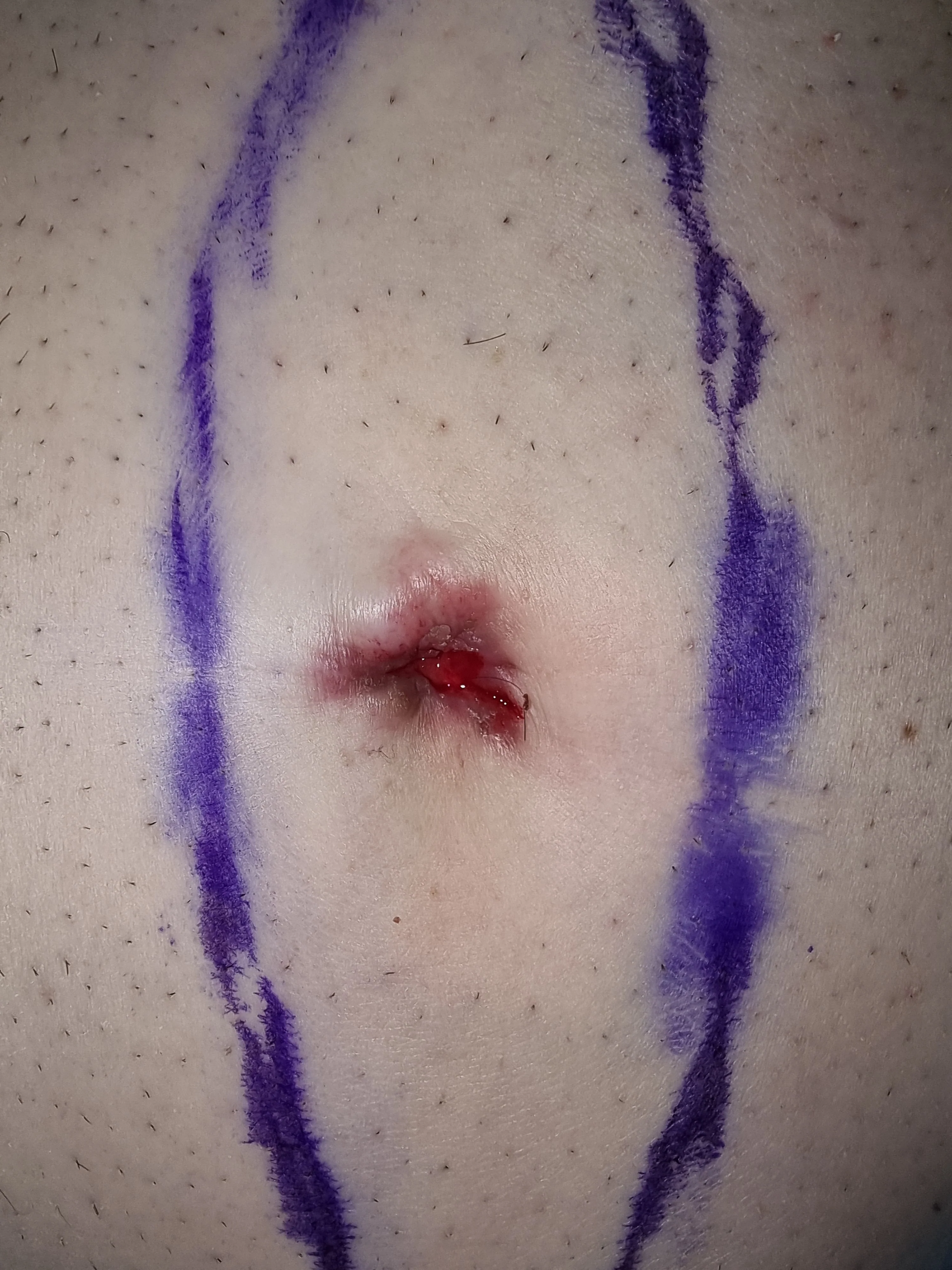 SISTER MARY'S JOSEPH NODULE - CHOLANGIOCARCINOMA RECURRENCE