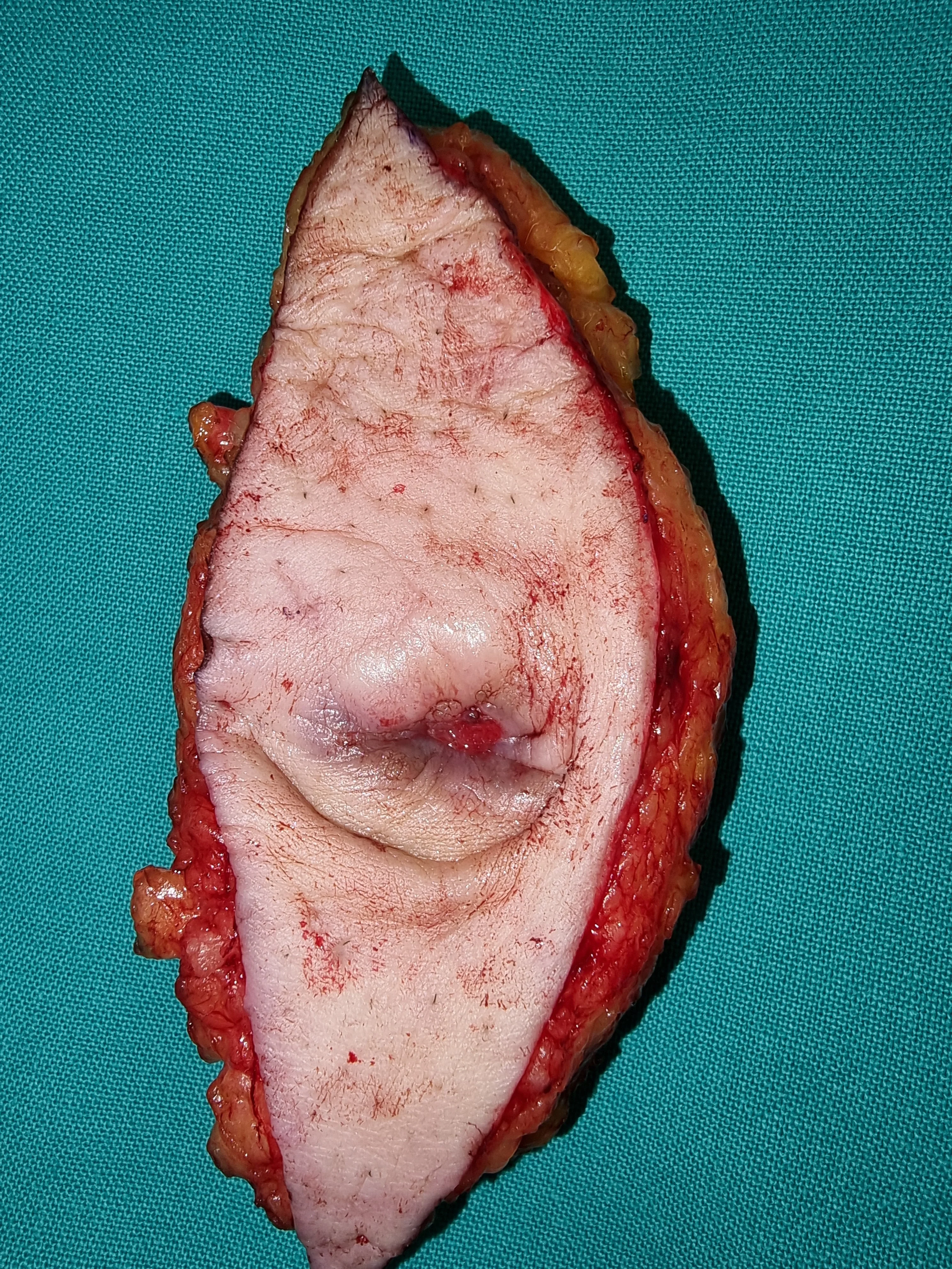 SISTER MARY'S JOSEPH NODULE - OMPHALECTOMY