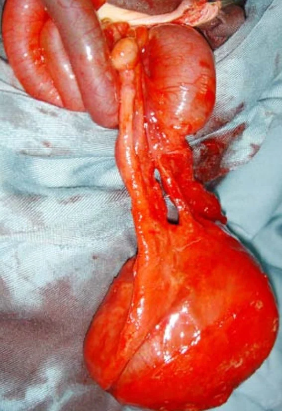 OMPHALOMESENTERIC DUCT CYST