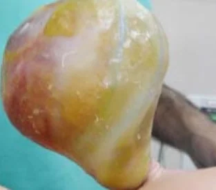 OMPHALOMESENTERIC DUCT CYST - OMPHALOCELE