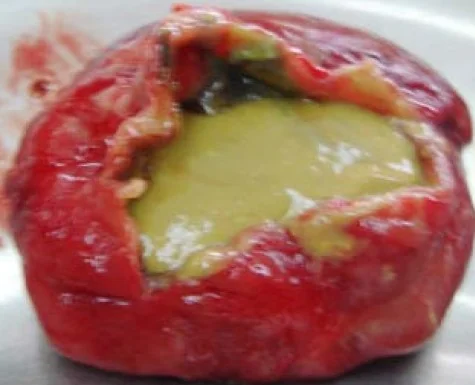 OMPHALOMESENTERIC DUCT CYST - INTESTINAL  CONTENTS