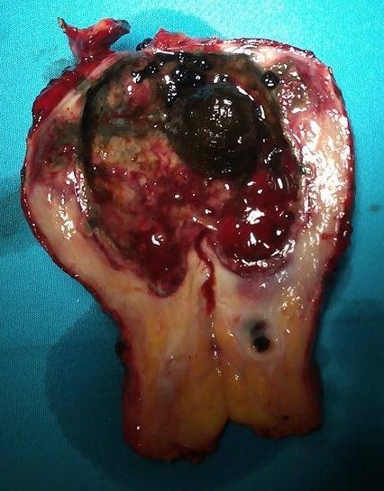 GALLSTONES - ACUTE CHOLECYSTITIS