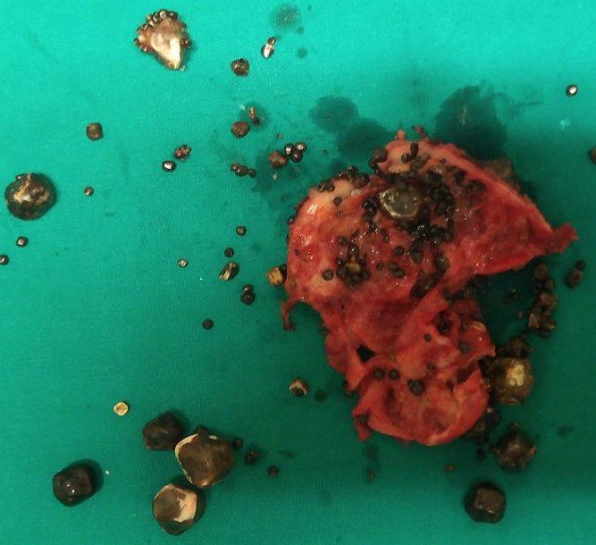 GALLSTONES - ACUTE CHOLECYSTITIS