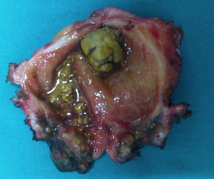GALLSTONES - ACUTE CHOLECYSTITIS