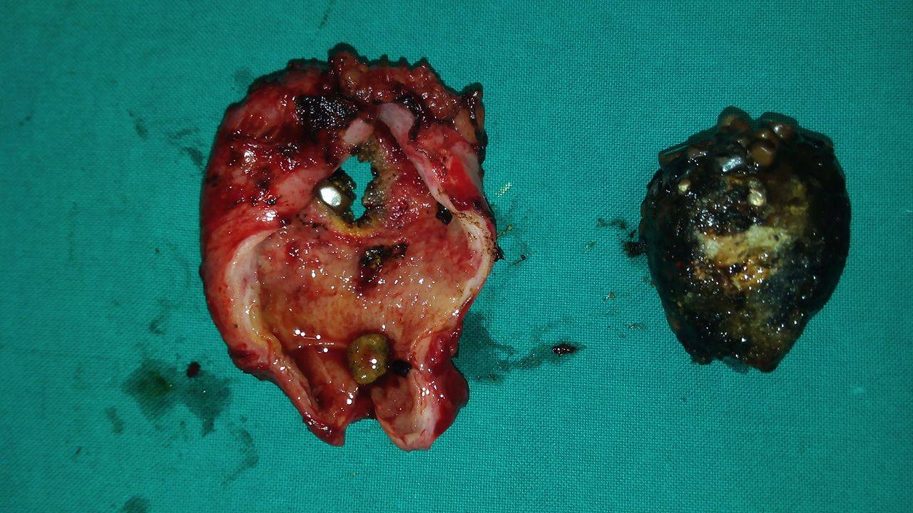 GALLSTONES - ACUTE CHOLECYSTITIS