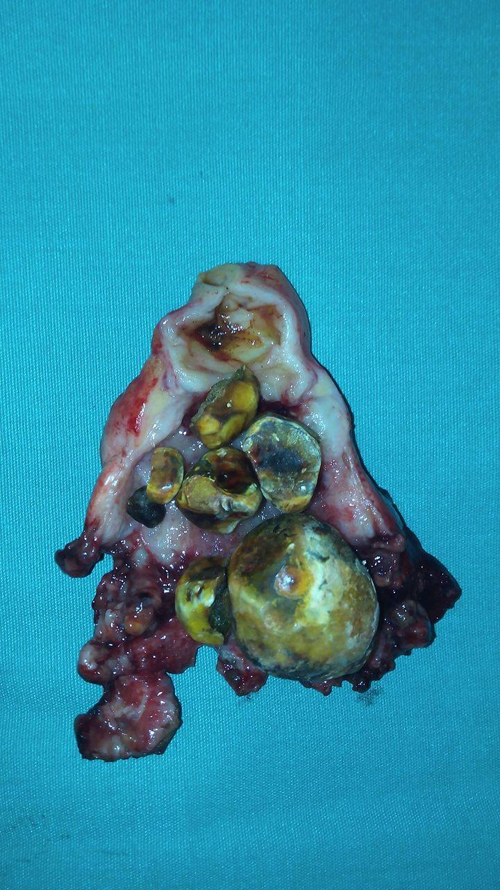 GALLSTONES - ACUTE CHOLECYSTITIS
