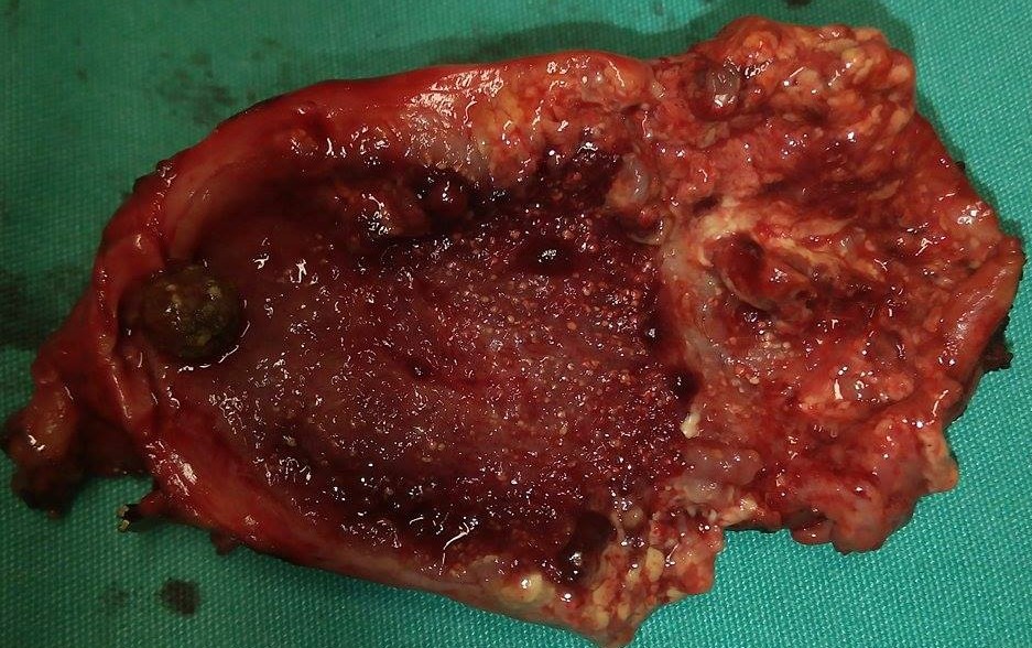 GALLSTONES - ACUTE CHOLECYSTITIS
