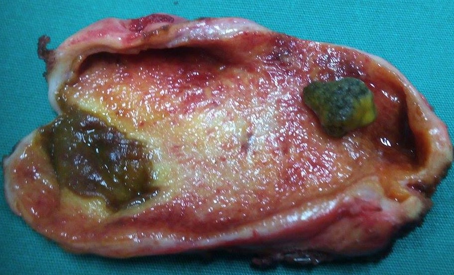 GALLSTONES - ACUTE CHOLECYSTITIS
