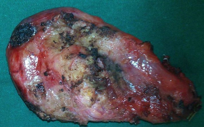 GANGRENOUS CHLECYSTITIS