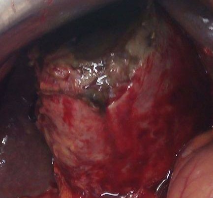 GANGRENOUS CHOLECYSTITIS