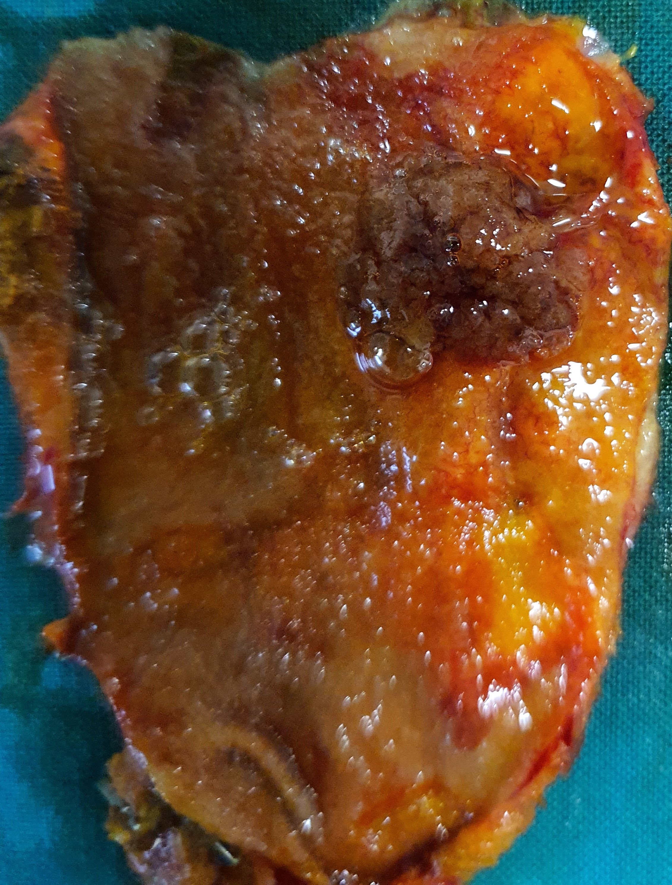 GALLBLADDER POLYPS