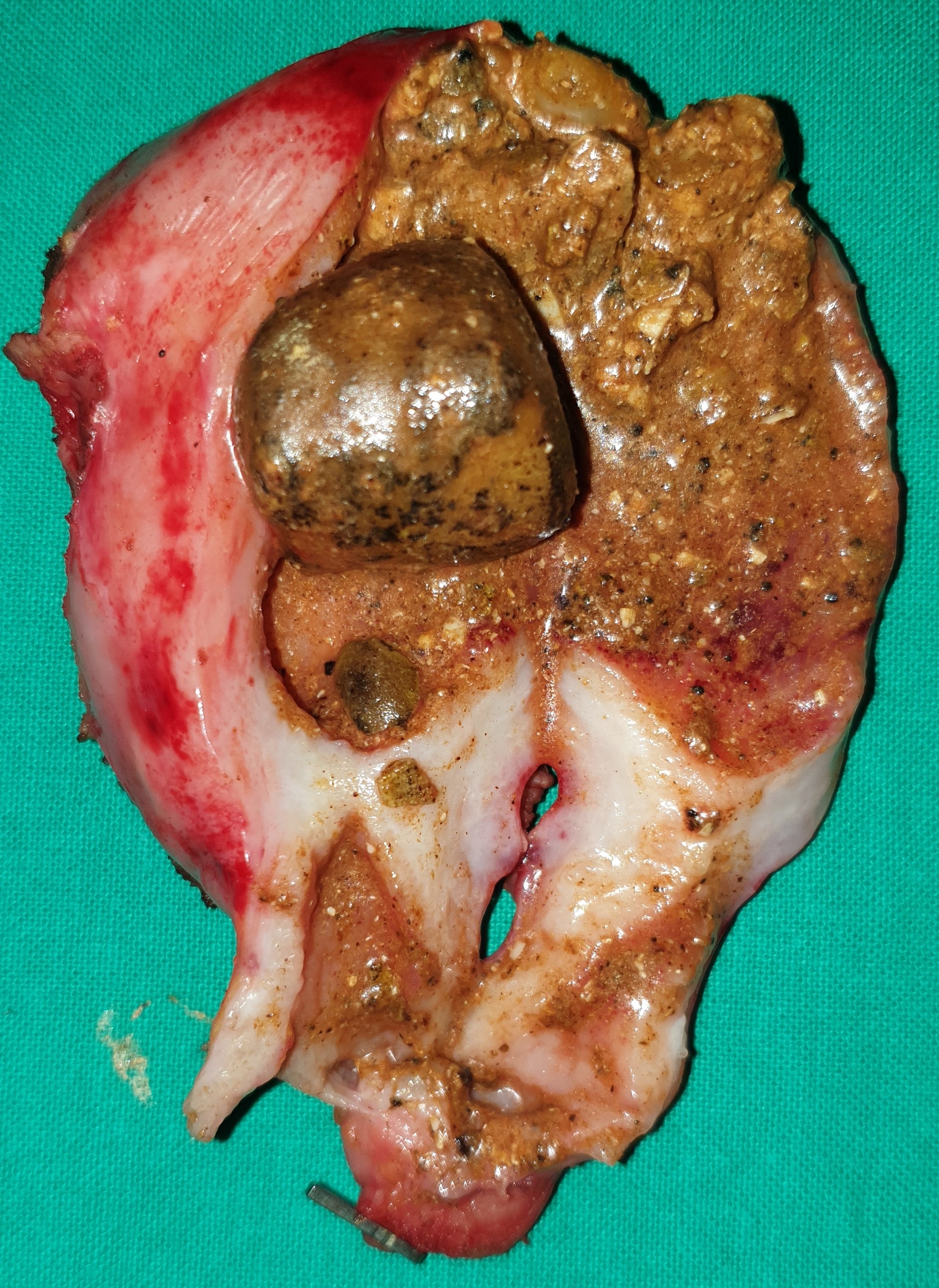 GALLSTONES - ACUTE CHOLECYSTITIS
