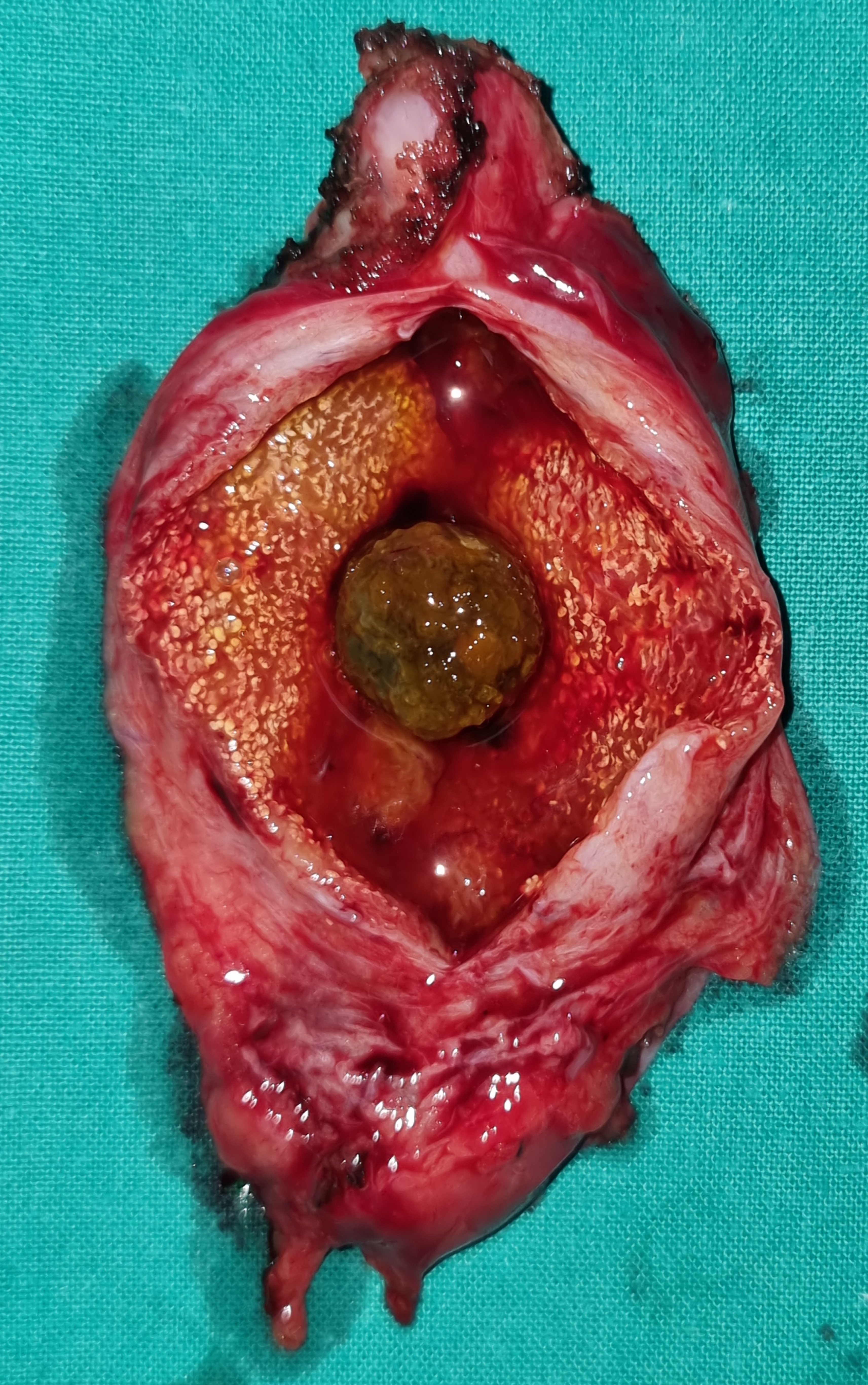 GALLSTONES - ACUTE CHOLECYSTITIS