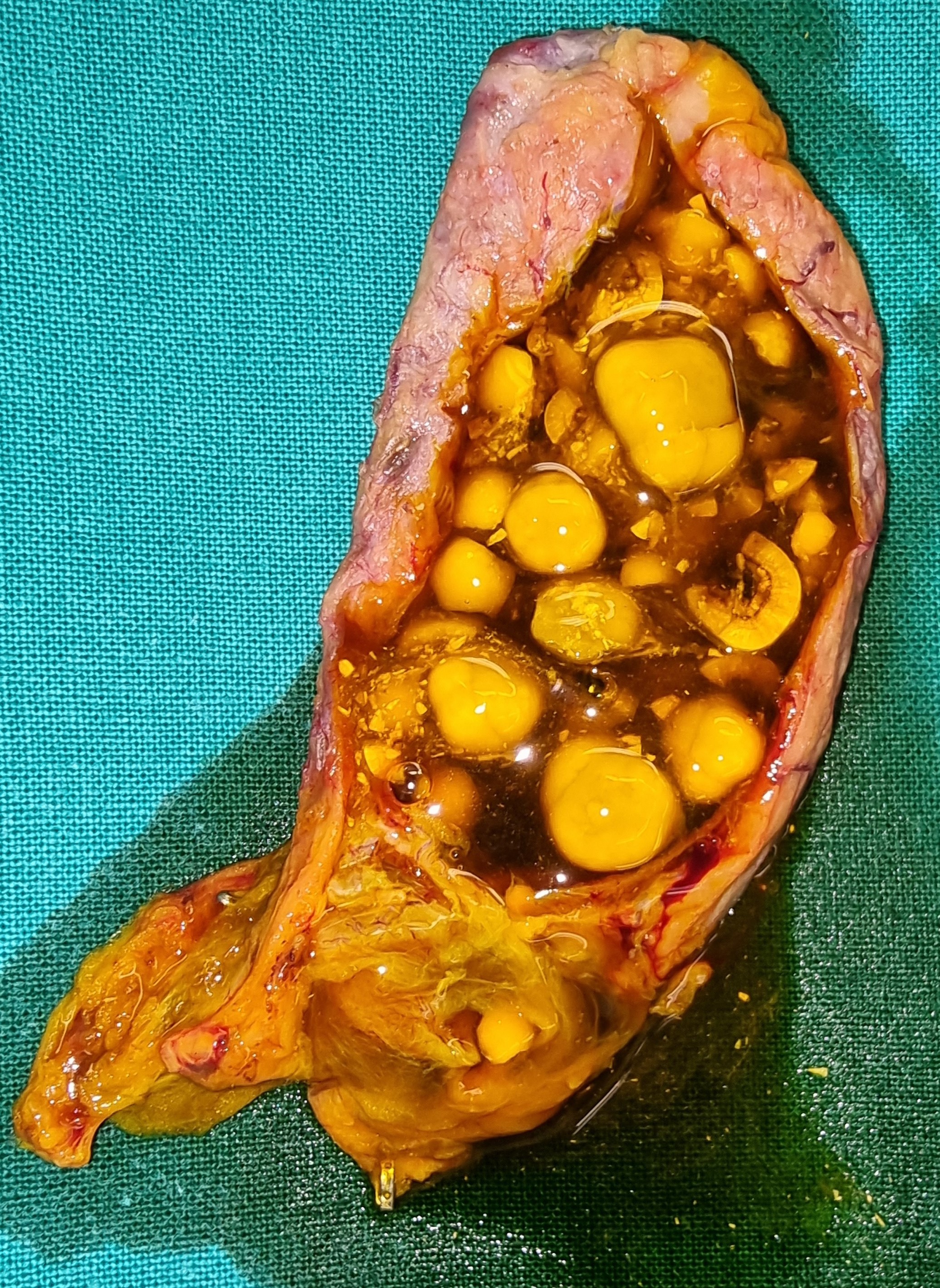 MULTIPLE GALLSTONES