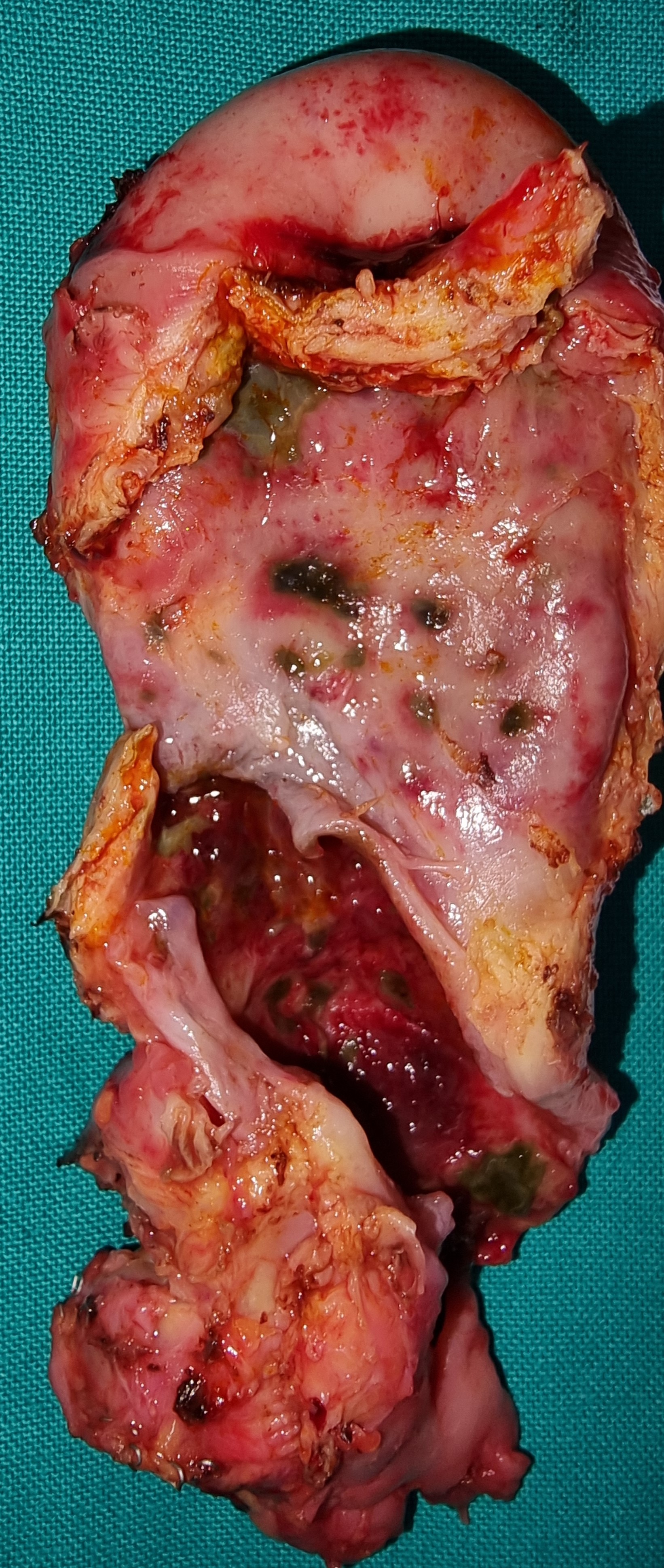 ACUTE CHOLECYSTITIS