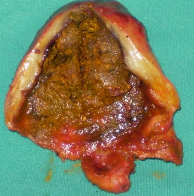 SYBTOTAL CHOLECYSTECTOMY