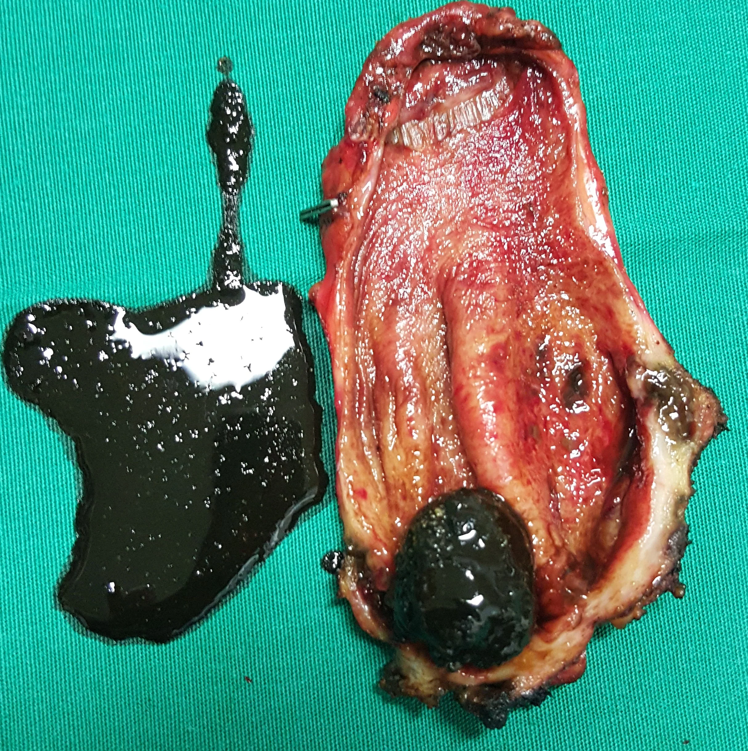 GALLBLADDER EMPYEMA