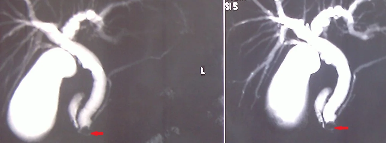 GALLBLADDER HYDROPS