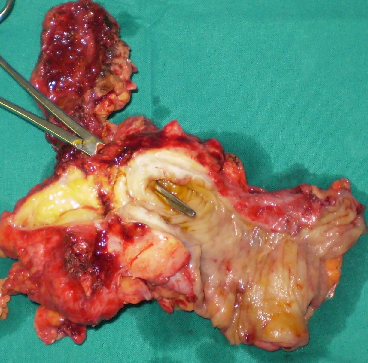 CHOLECYSTOCOLIC FISTULA